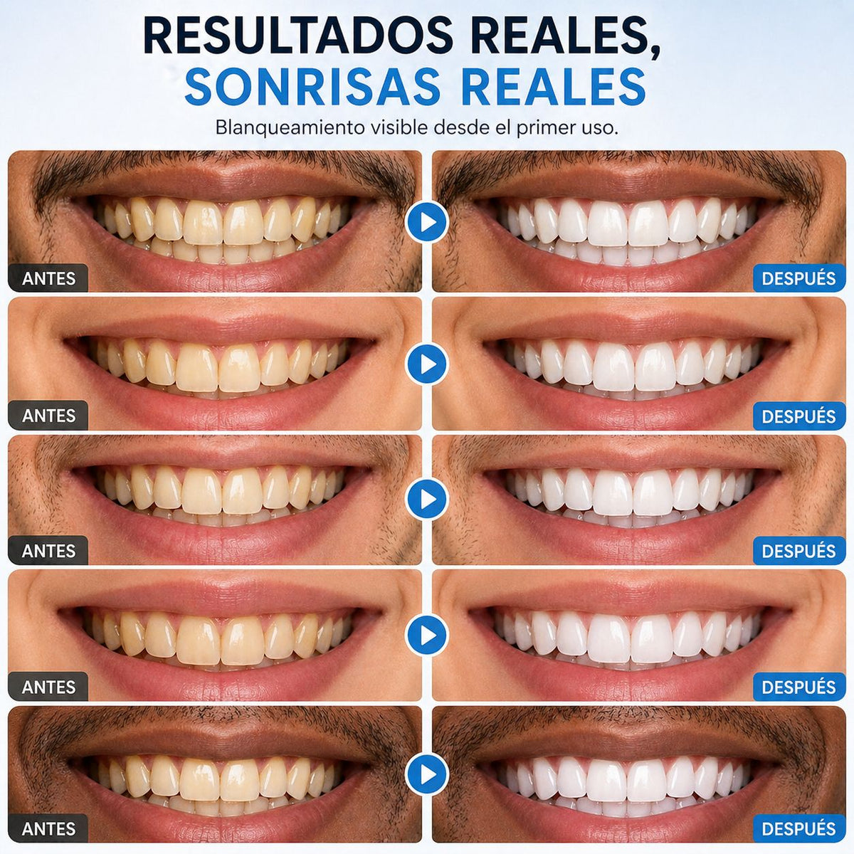 Luminex Kit de Blanqueamiento Dental